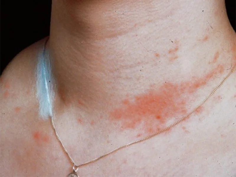 از کجا بفهمیم به نقره حساسیت داریم - جوشن گلد