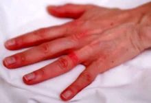 از کجا بفهمیم به نقره حساسیت داریم