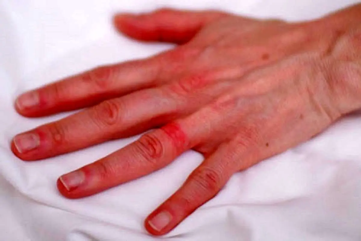 از کجا بفهمیم به نقره حساسیت داریم